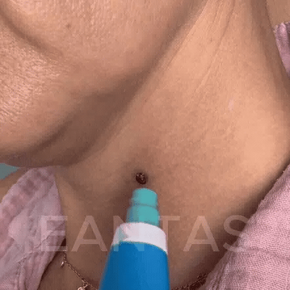 PureSkin Pro™ – Kit Anti-Excroissances | Peau Lisse Garantie en 4 Jours, Chez Vous