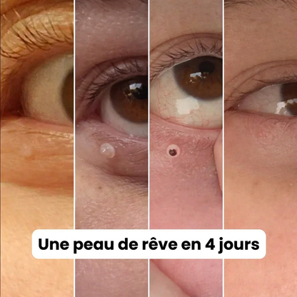 PureSkin Pro™ – Kit Anti-Excroissances | Peau Lisse Garantie en 4 Jours, Chez Vous