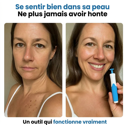PureSkin Pro™ – Kit Anti-Excroissances | Peau Lisse Garantie en 4 Jours, Chez Vous